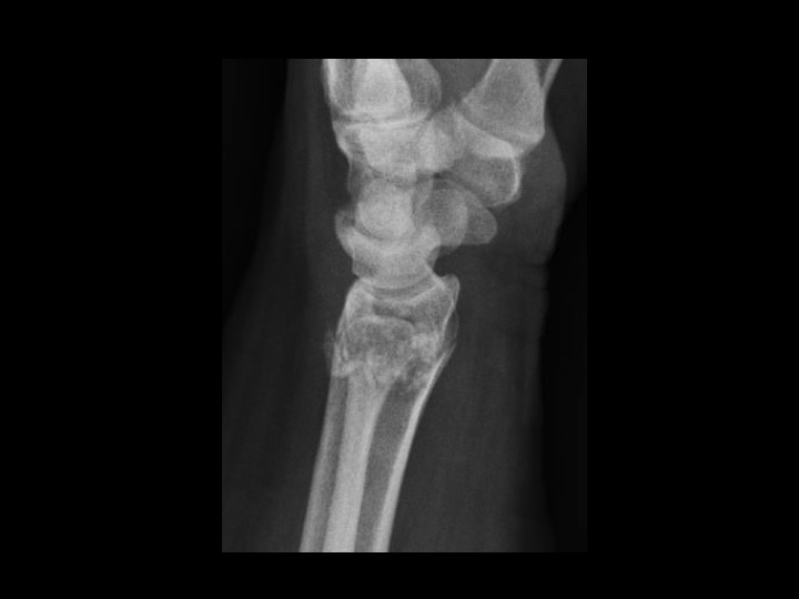 Figure 3 for case enchondroma ( RID4128 )